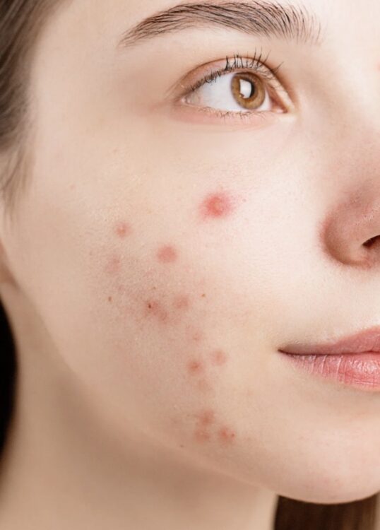 白ニキビと黒ニキビ