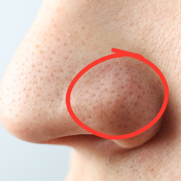 この時期オススメの毛穴悩み撃退メニュー